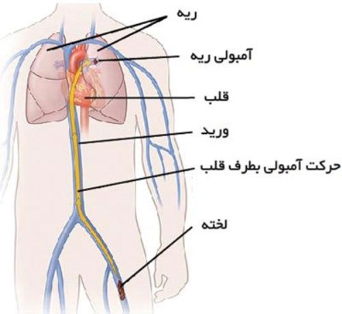 آمبولی ریوی چیست و چگونه درمان می شود