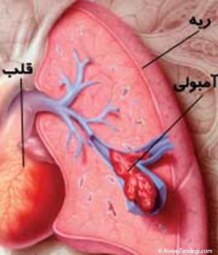 آمبولی ریوی چیست و چگونه درمان می شود