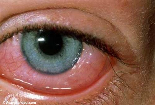 آشنایی با حساسیت های چشمی و درمان آن ها 