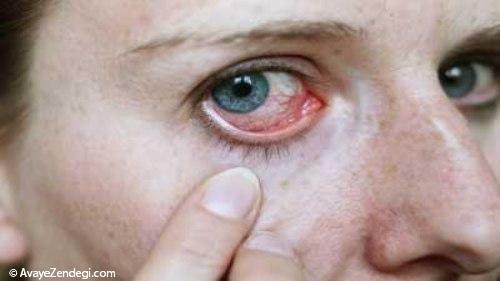 آشنایی با حساسیت های چشمی و درمان آن ها 