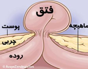 درمان فتق شکم و اقدامات پس از عمل فتق 