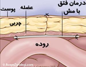 درمان فتق شکم و اقدامات پس از عمل فتق 