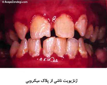  انواع بیماری های لثه و راهای درمان آن 