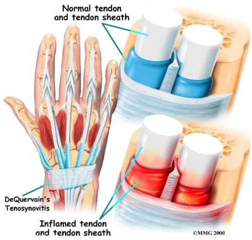 حرکاتی برای درمان التهاب تاندون مچ دست