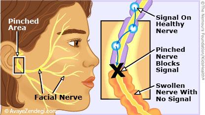  فلج بل (Bell's palsy) با کودک چه می کند؟ 