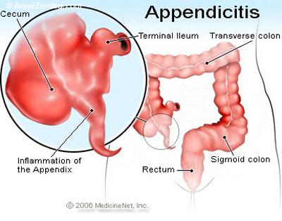 هرآنچه لازم است درباره «آپاندیسیت» بدانید