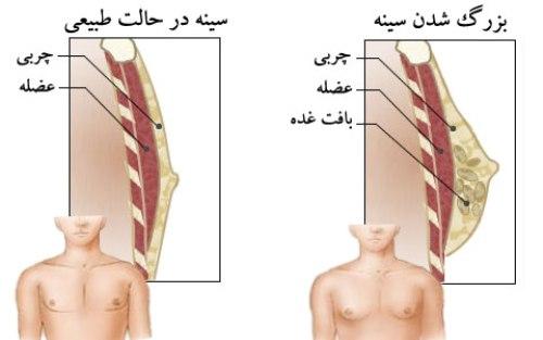 علت بزرگ شدن سینه مردان و ارتباط داروهای بدنسازی با آن