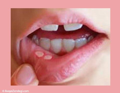 درمان گیاهی و خانگی آفت دهان