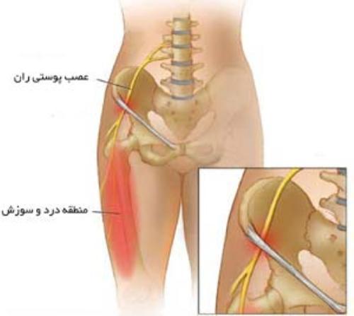  درد سوزشی ران پا 