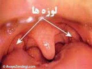  توصیه های لازم بعد از جراحی لوزه 