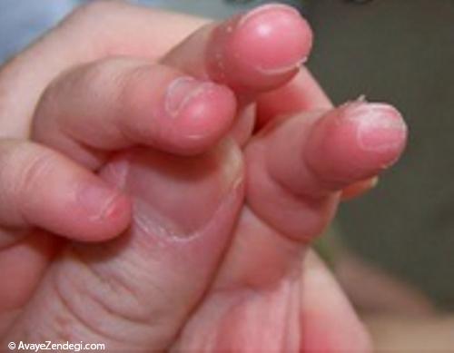 15 درمان خانگی نوک انگشتان پوسته پوسته