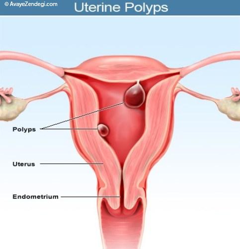پلیپ رحم را با تغذیه کنترل کنید