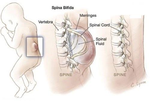 بیماری اسپاینا بیفیدا چیست؟ 