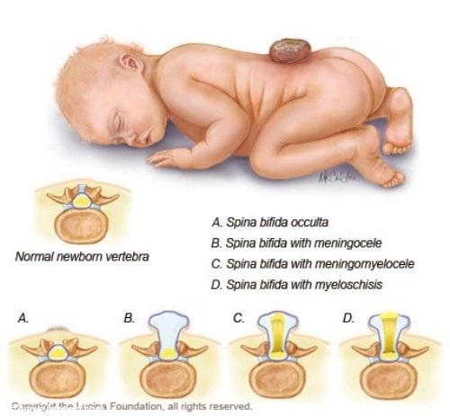 بیماری اسپاینا بیفیدا چیست؟ 