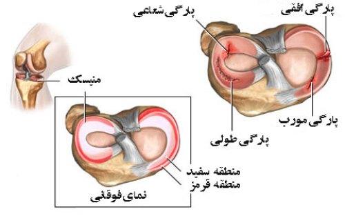  آسیب های زانو 