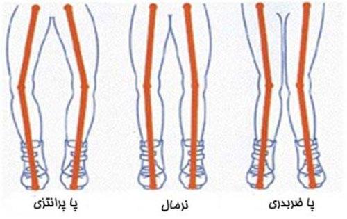 آیا کودک شما پای پرانتزی دارد؟ آیا کودک شما پای پرانتزی دارد؟