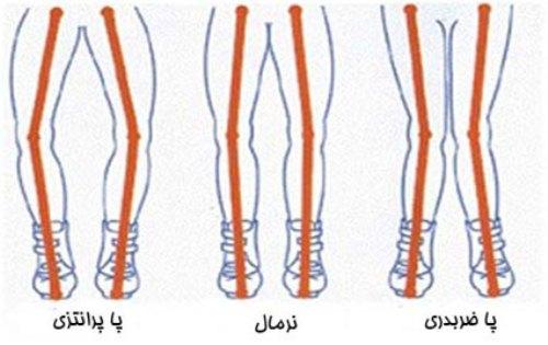 آیا کودک شما پای پرانتزی دارد؟ 