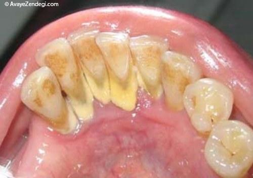 پلاک میکروبی و جرم دندان چیست؟