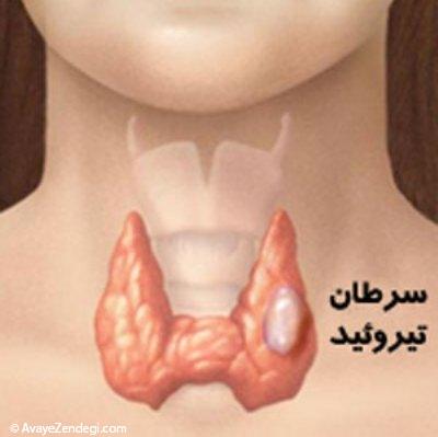  راه های درمان سرطان تیروئید 