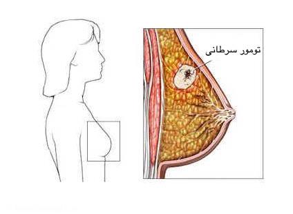 با ورزش ریسک بوجود آمدن سرطان سینه پس از یائسگی را کاهش دهیم