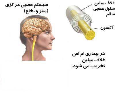 چه کار کنیم تا ام اس (MS) نگیریم؟