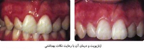 بیماریهای لثه ،نشانه‌های بیماری لثه 