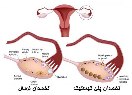 کیست تخمدان و علائم حاد كیست تخمدان