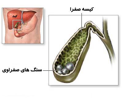 سنگ کیسه صفرا: بخورها و نخورها