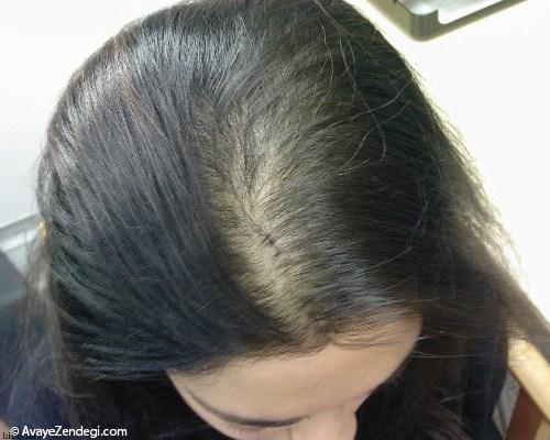 درمان ریزش مو با طب سنتی