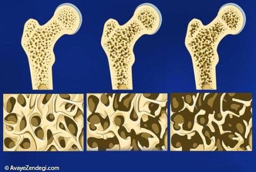 10 نکته برای پیشگیری از ابتلا به پوکی استخوان