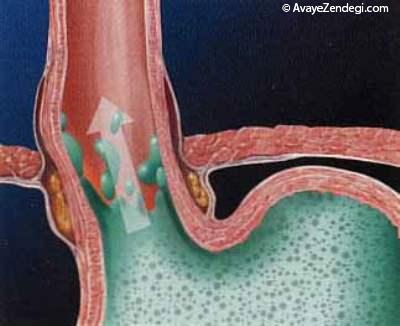8 ماده غذایی که اسید معده را بالا می آورد (2)