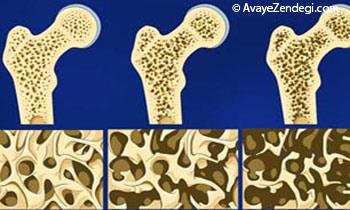 10 توصیه مهم برای تقویت استخوا‌ن‌ها 