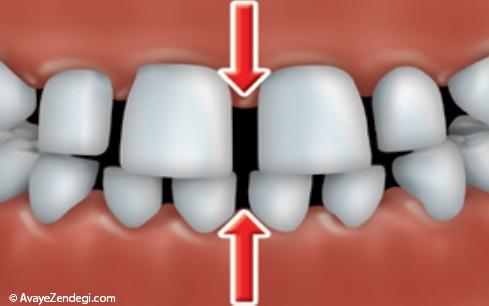 فاصله دندانی چیست؟