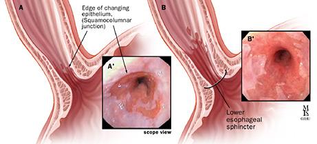 از بیماری مری بارت (Barrett’s esophagus) چه میدانید؟