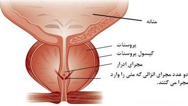 خروج مایع منی با ادرار نشان دهنده این مشکل