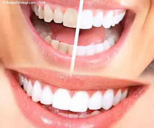 حد و مرز و خط قرمزهای شفاف کردن دندان