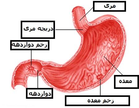 زخم معده دارید؟ از این ها بپرهیزید