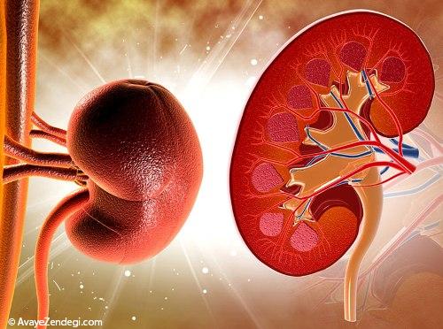 سنگ کلیه و رژیم غذایی