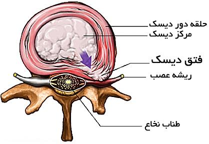وقتی دیسک کمر بیرون می زند 