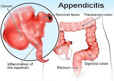 وقتی آپاندیس دردناک می‌شود 