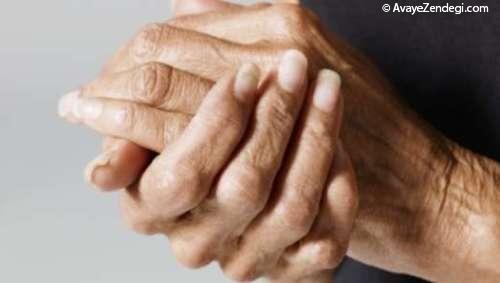 5 عامل رایج ابتلا به آرتروز