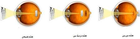  چرا چشم‌ها خوب نمی‌بینند؟ 