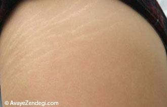  چه عواملی باعث ایجاد ترکهای پوستی در باردرای می شود؟ 