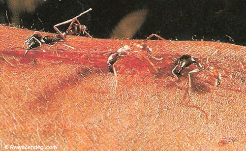  استفاده از مورچه ها برای بخیه زدن زخم 