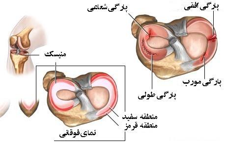 10 راه درمان پارگی منیسک زانو 