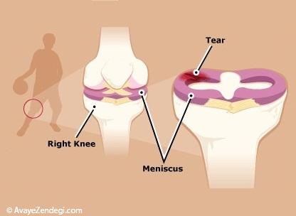 10 راه درمان پارگی منیسک زانو