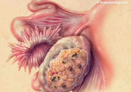 چه عواملی باعث سرطان تخمدان می شوند؟