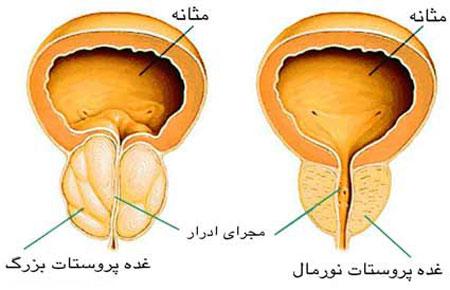 سرطان خاموش در کمین مردان ایرانی