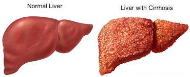 انواع نارسایی های کبد و راههای پیشگیری از آن