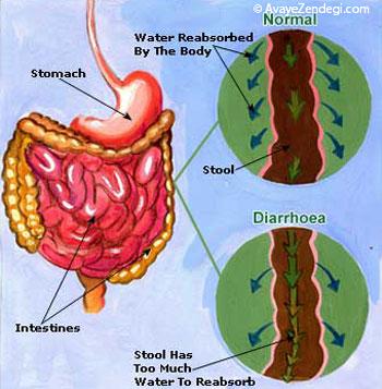   موقع اسهال از خوردن این غذاها بپرهیزید 